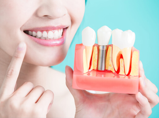Dental-Implants_img
