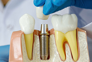 img-Implant-Dentistry